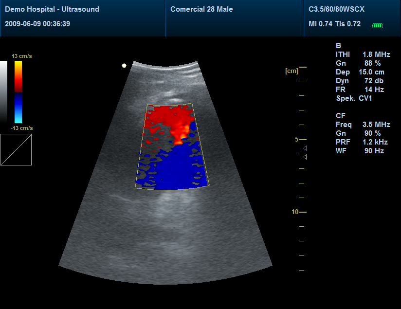 Eco doppler: Modo CF (Doppler color) Representa las velocidades de los flujos mediante una codificación de colores superpuesta a la imagen en modo B o B/M. aportándonos información acerca de la magnitud, dirección y sentido del flujo.