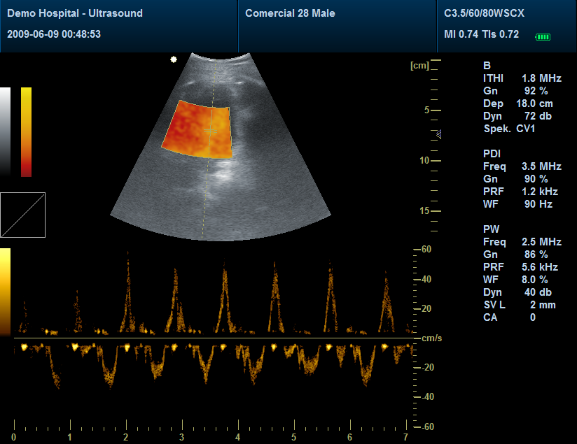 Eco doppler: Modo PDI/DPDI (Power doppler imaging) Asigna un color de fondo uniforme al ruido y puede detectar velocidades relativamente bajas y es más sensible a los estados de bajo flujo.