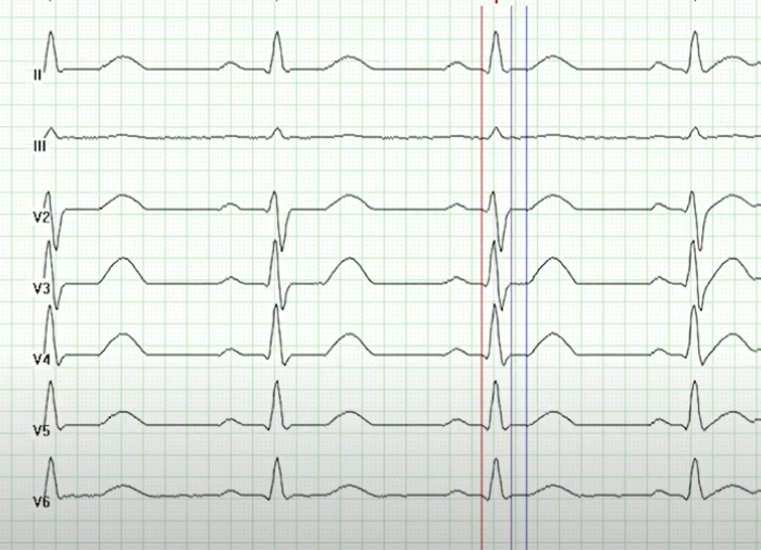 Holter de arritmias: Holter Dinámico con 12 derivaciones con la capacidad de registrar hasta 48 horas el estudio electrocardiográfico, sus alteraciones, y ser interpretadas con su software integrado.