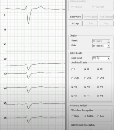 Holter de arritmia:Predice arritmias malignas y muerte cardiaca súbita.